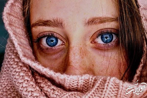 تیرگی اطراف چشم سیاهی زیر چشم